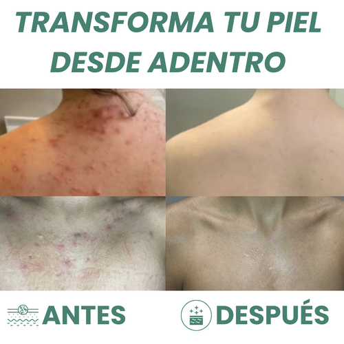 Limpiador corporal para el acné / Caelia ™