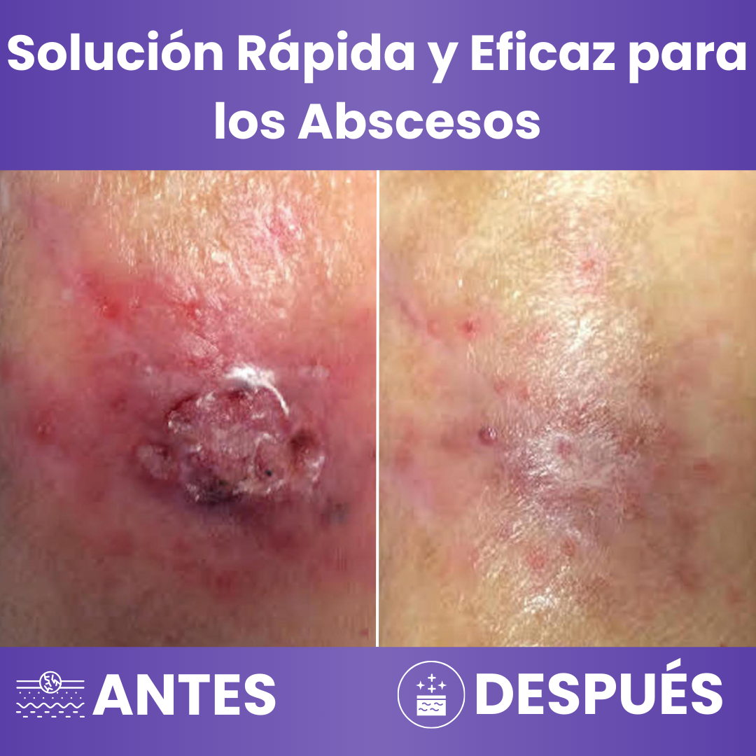 Caelia™ Crema Intensiva Para Abscesos